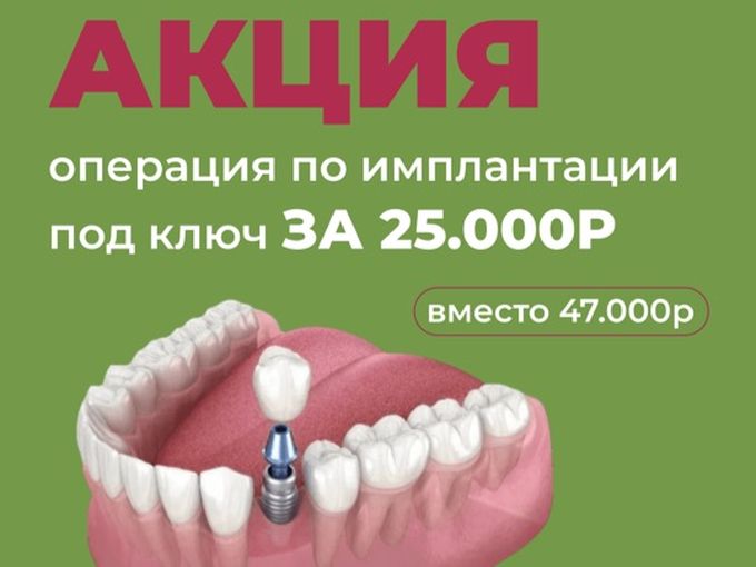 Имплантация под ключ — за 25 000 ₽!
