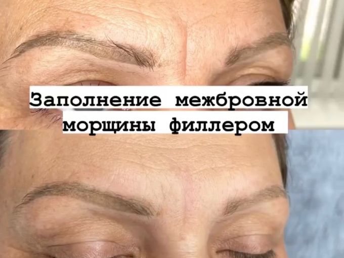 Скажи НЕТ морщинам