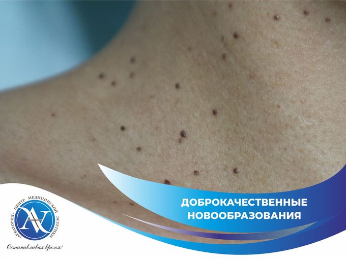 Папилломы: удаляем безопасно! ✨