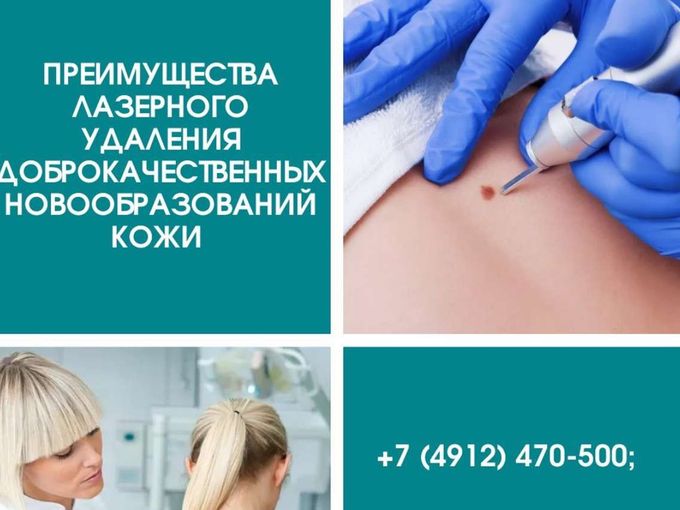 Лазерное удаление новообразований