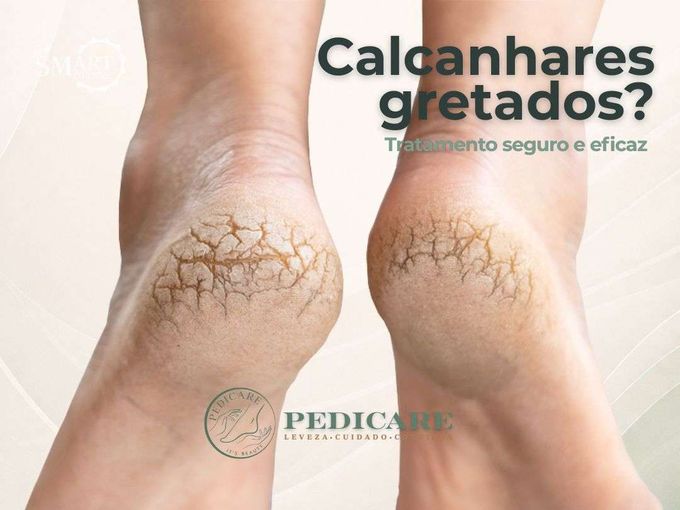 Calcanhares gretados?