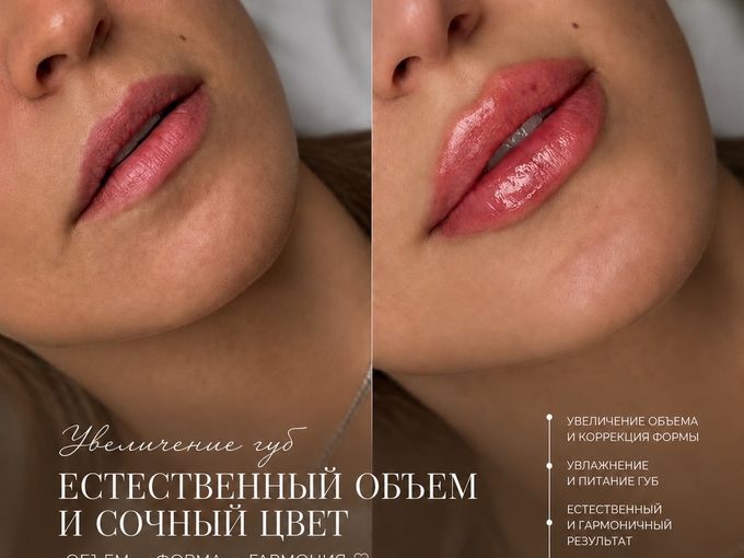 Увеличение губ "Естественный объем"