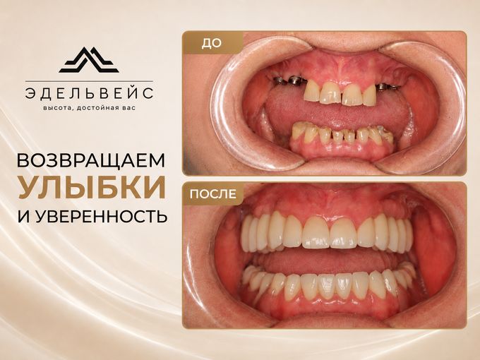 🦷 73 года — и новая улыбка возможна