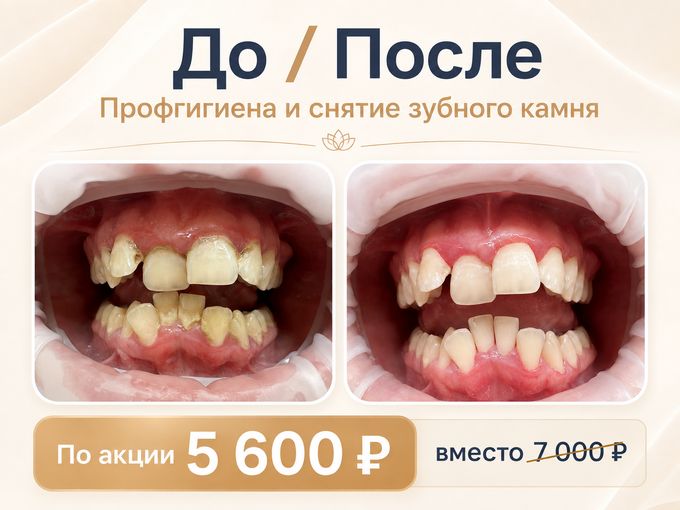 🔥АКЦИЯ  на профгигиену! Успевайте!