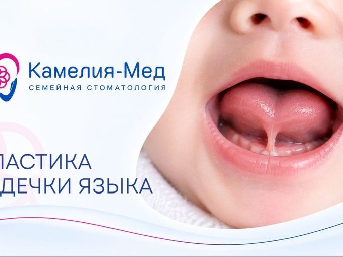 Рекомендовали пластику уздечки языка?🤔