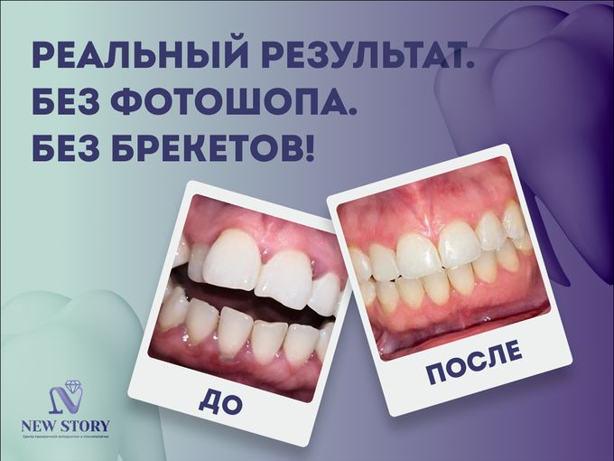 Реальный результат.  Без брекетов!
