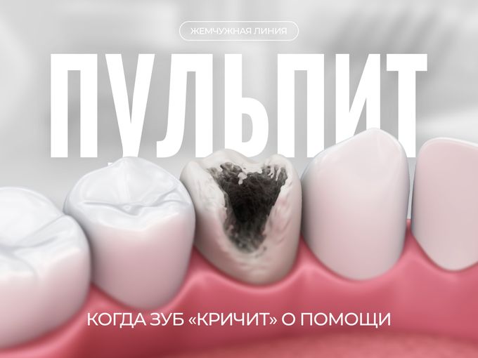 Пульпит: когда зуб «кричит» о помощи 💥