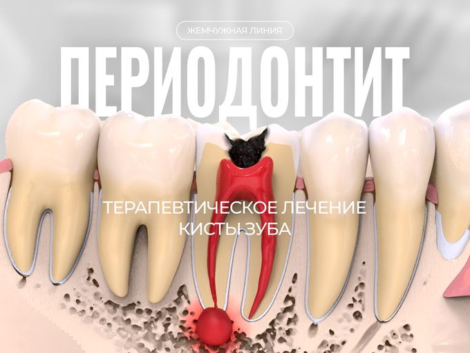 Терапевтическое лечение кисты зуба 🦷