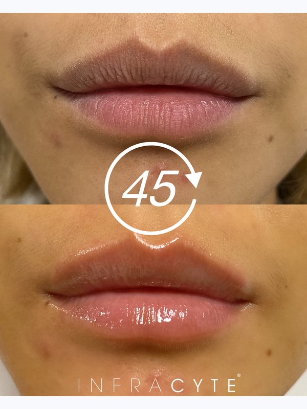 L.I.T. (Lip Infusion Therapy)