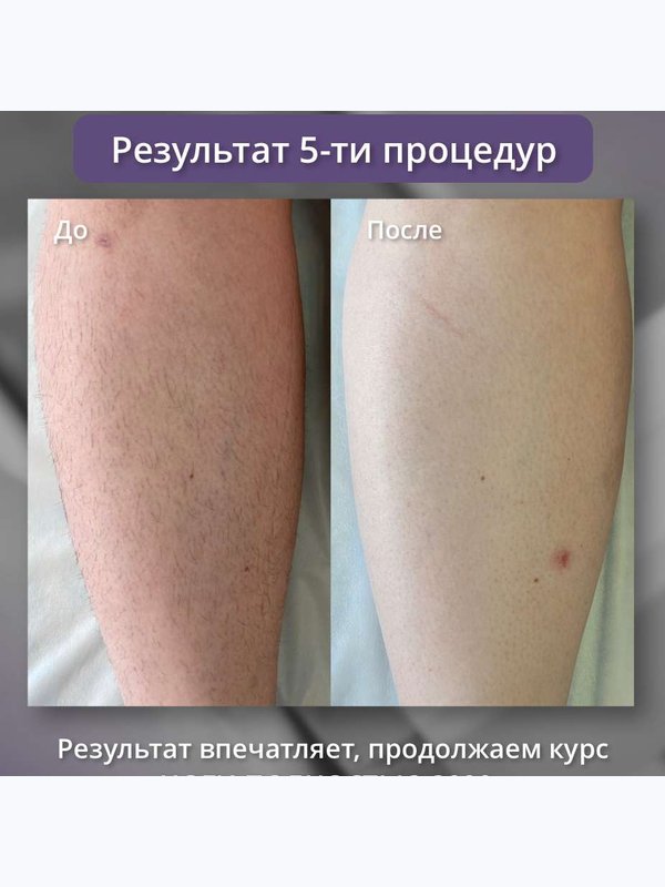 Диодный лазер - голени