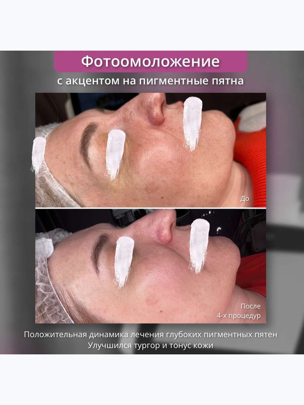 Фотоомоложение, эффект “фотошопа” для вашей кожи (IPL-терапия). Лицо без лба