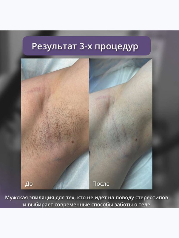Александритовый лазер - подмышки