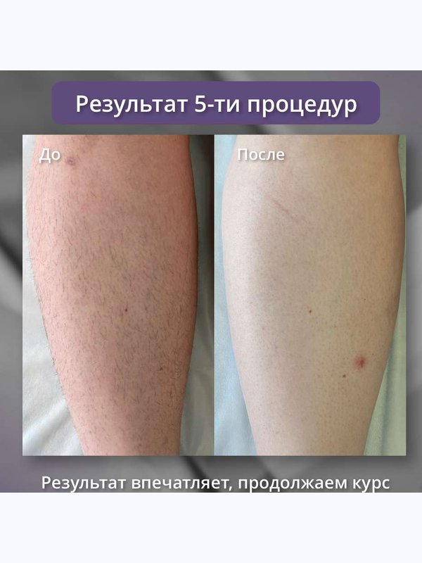 Диодный лазер - руки до локтей