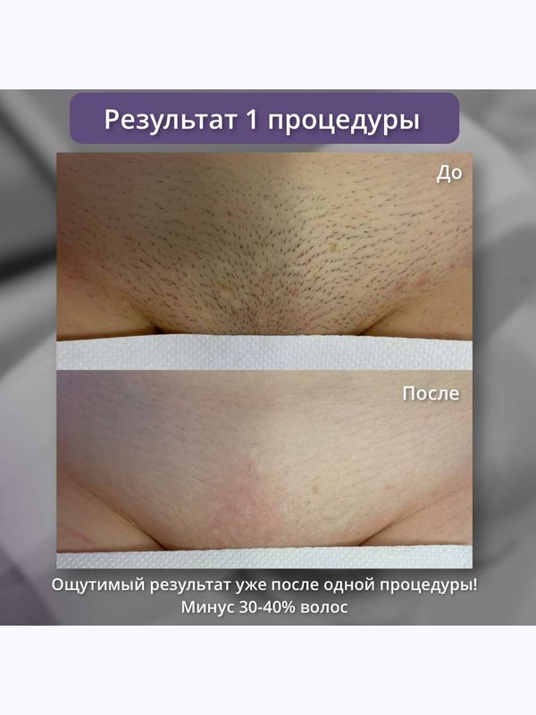 Диодный лазер ( бикини + подмышки + ноги )