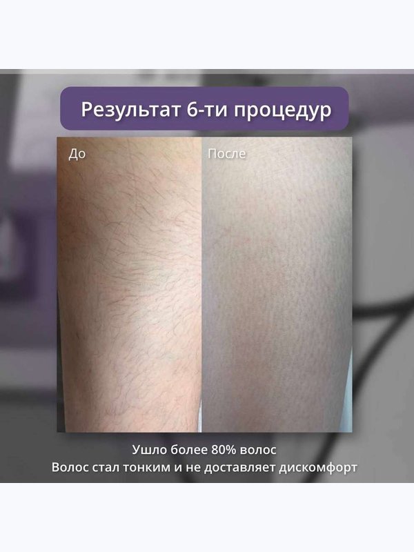 Александритовый лазер - ареолы