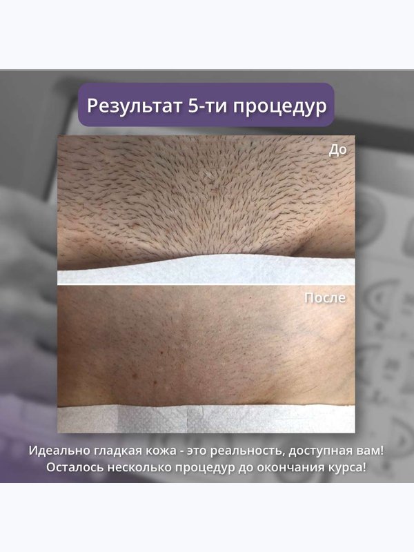 Александритовый лазер ( бикини и подмышки )
