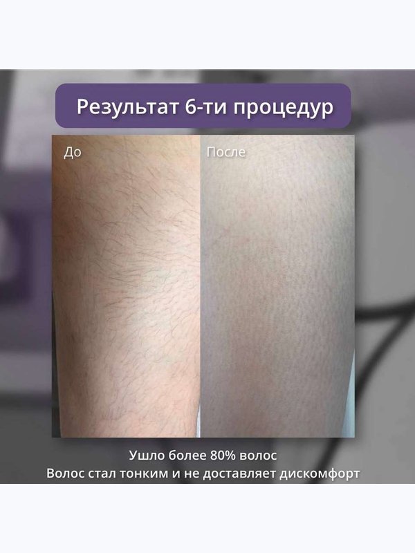 Александритовый лазер - руки  полностью