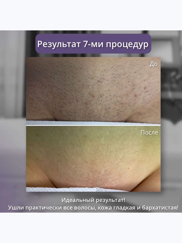 Александритовый лазер - глубокое бикини