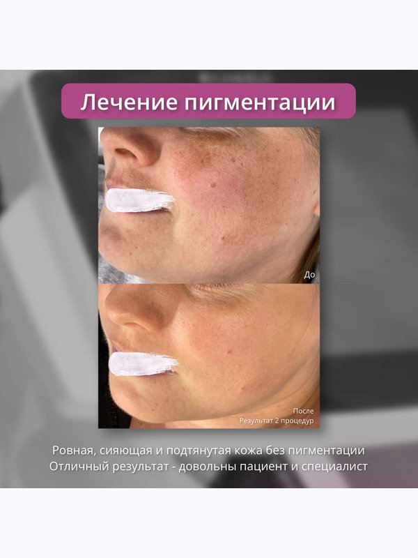 Удаление пигментации (фототерапия кожи) Щечно-скуловая зона