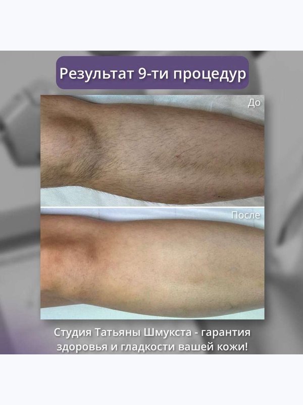Александритовый лазер - ноги полностью