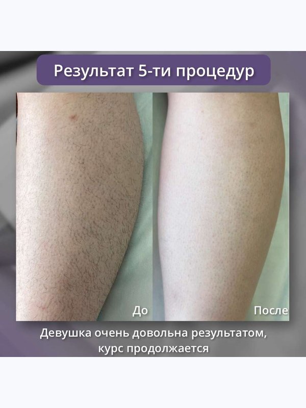 Диодный лазер - ноги полностью