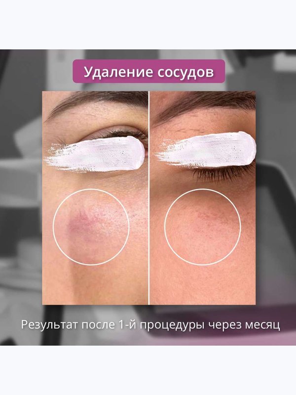 Удаление сосудов (фототерапия кожи) Щечно-скуловая зона