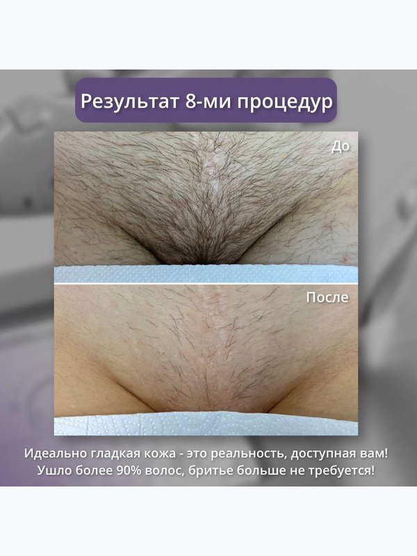 Александритовый лазер ( бикини + подмышки + ноги полностью )