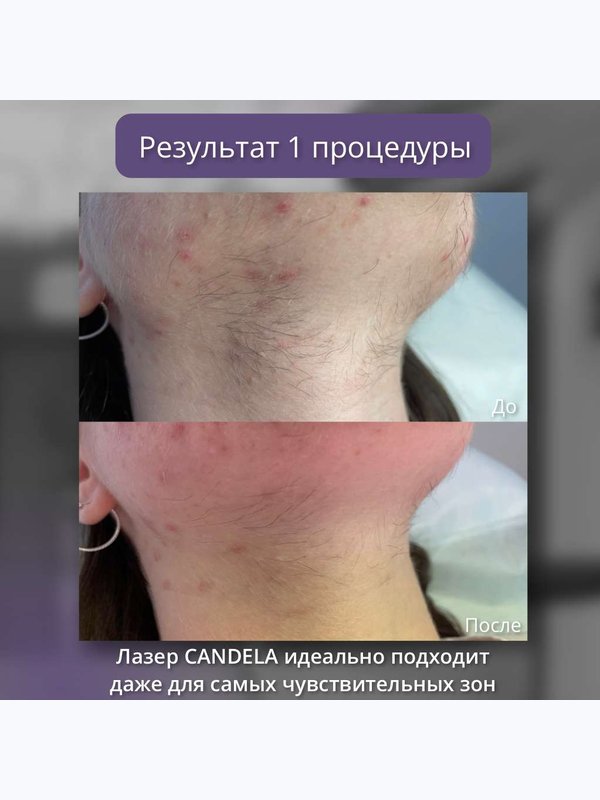 Александритовый лазер - лицо
