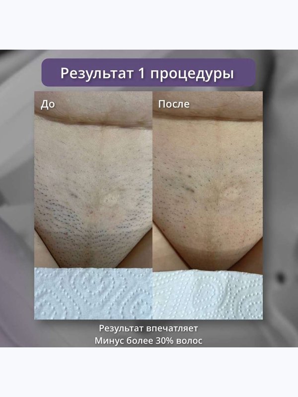 Диодный лазер ( голени и глубокое бикини )