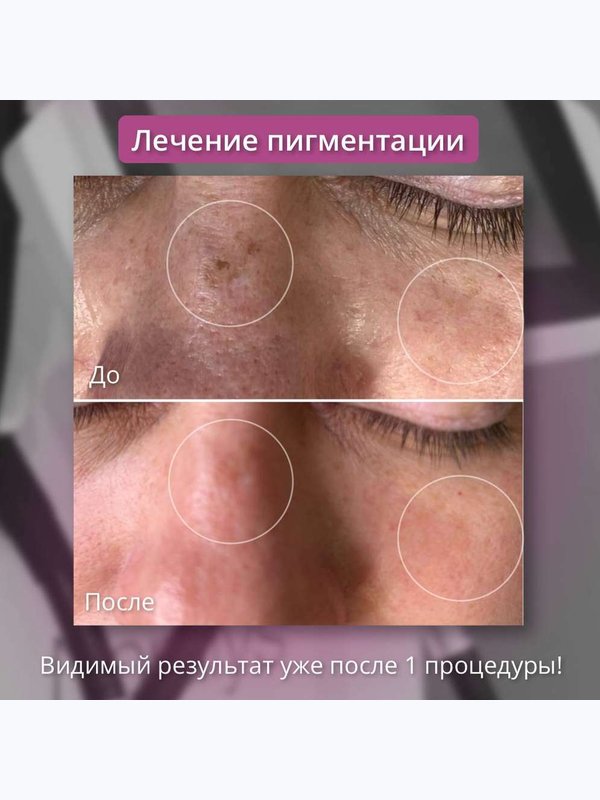 Удаление пигментации (фототерапия кожи). Нос
