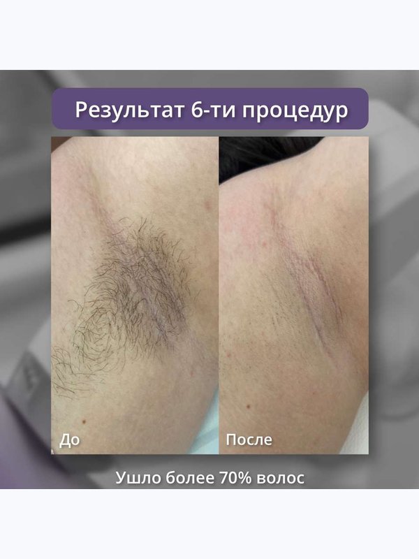 Диодный лазер ( бикини и подмышки )