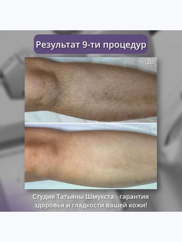 Александритовый лазер - голени