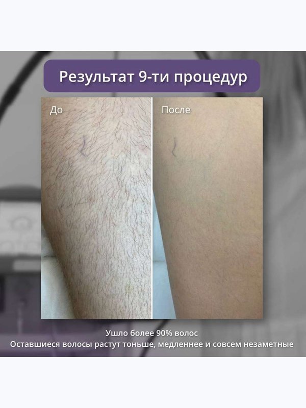 Александритовый лазер - поясница