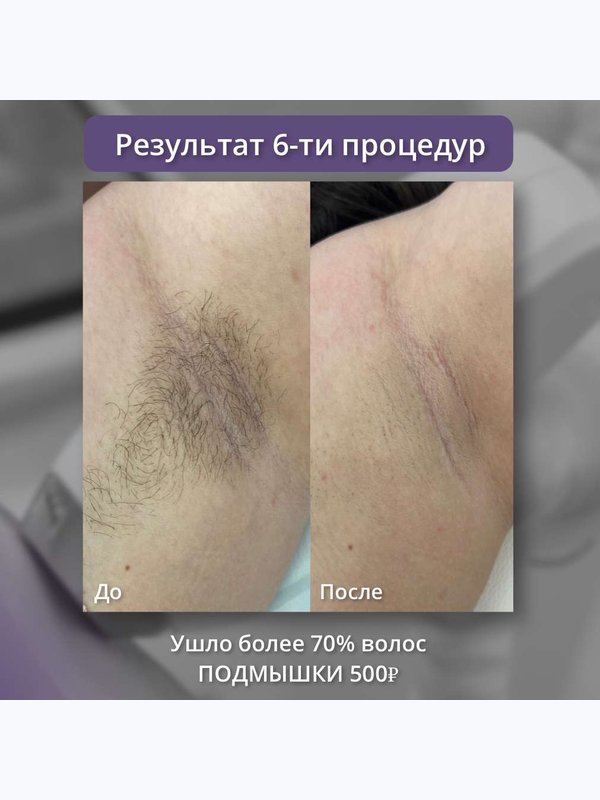 Диодный лазер - подмышки