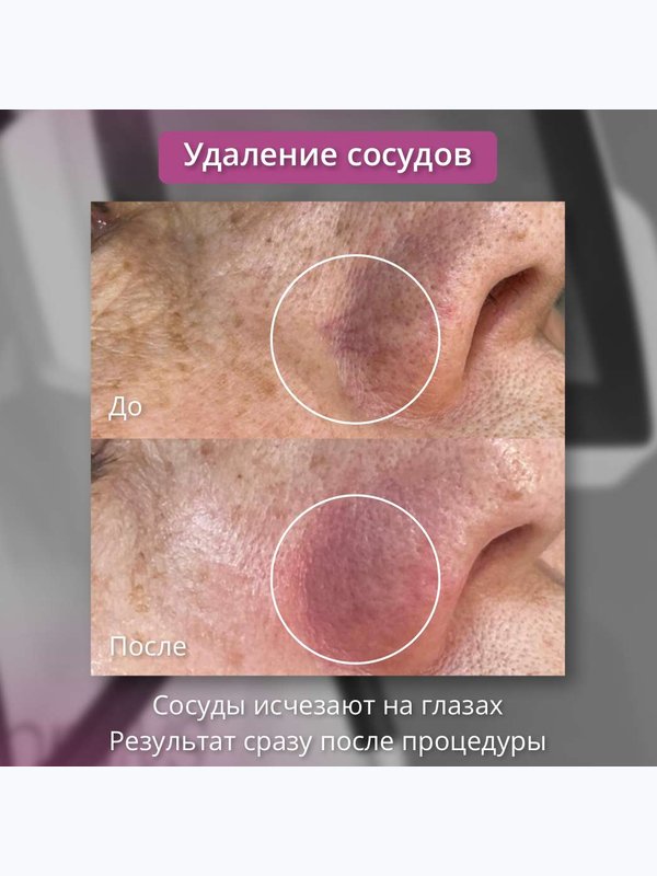 Удаление сосудов (фототерапия кожи) на носу