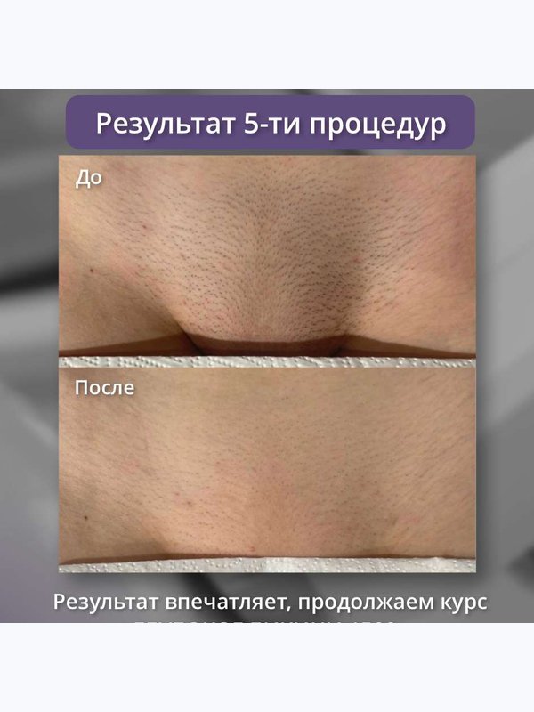 Диодный лазер ( бикини + подмышки + голени )