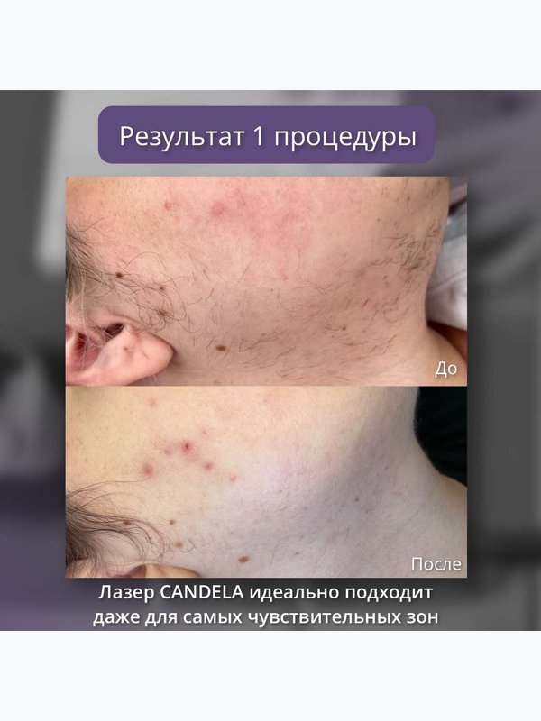 Александритовый лазер - носогубка