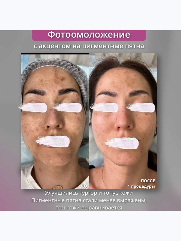 Фотоомоложение, эффект “фотошопа” для вашей кожи (IPL-терапия). Лицо полностью