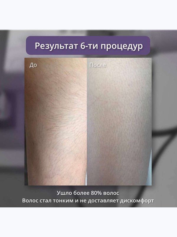 Александритовый лазер - линия на животе