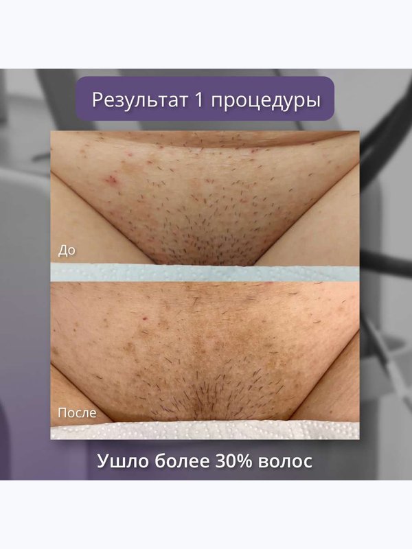 Александритовый лазер ( бикини + подмышки + голени )