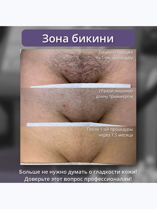Александритовый лазер - бикини классика