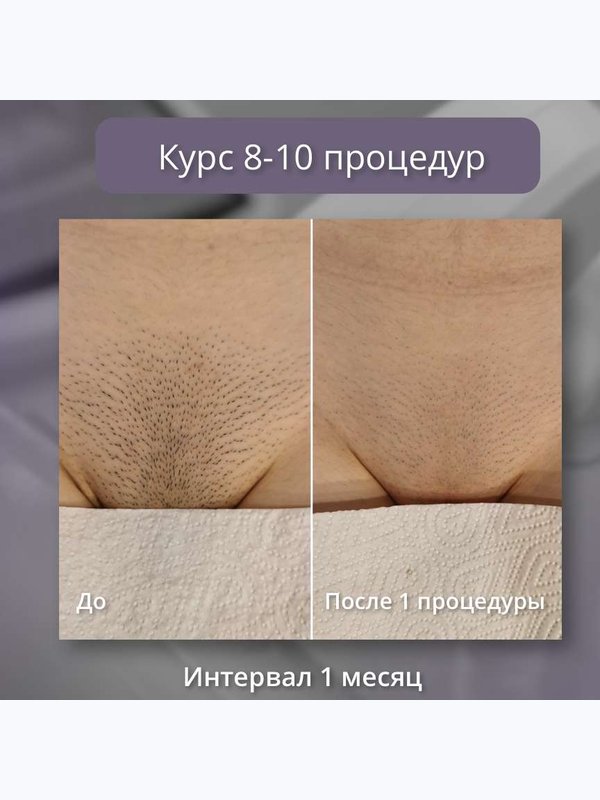 Диодный лазер - бикини (классика)