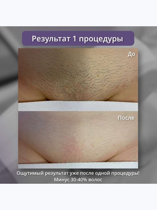 Диодный лазер - глубокое бикини
