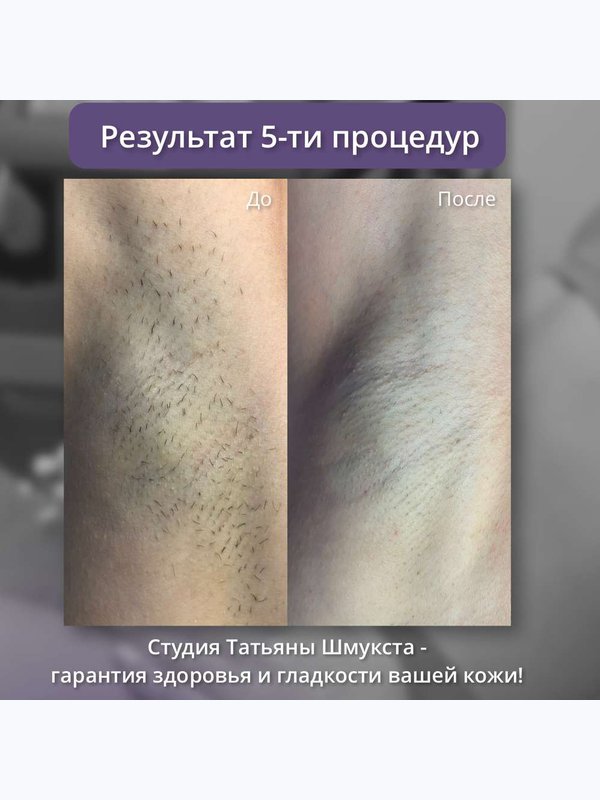 Александритовый лазер ( голени и подмышки )