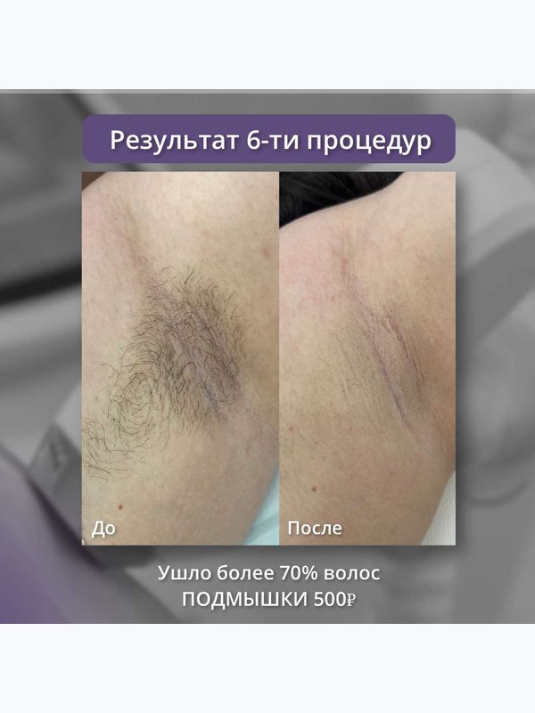 Диодный лазер ( голень и подмышки )