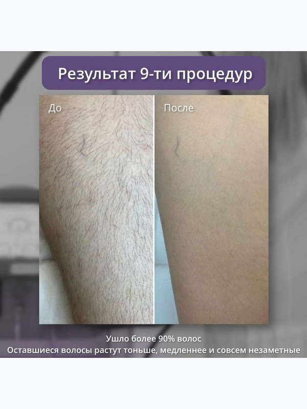 Александритовый лазер - бедра