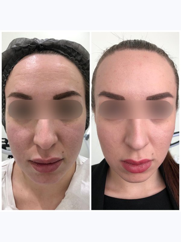 Безоперационный лифтинг FACE UP