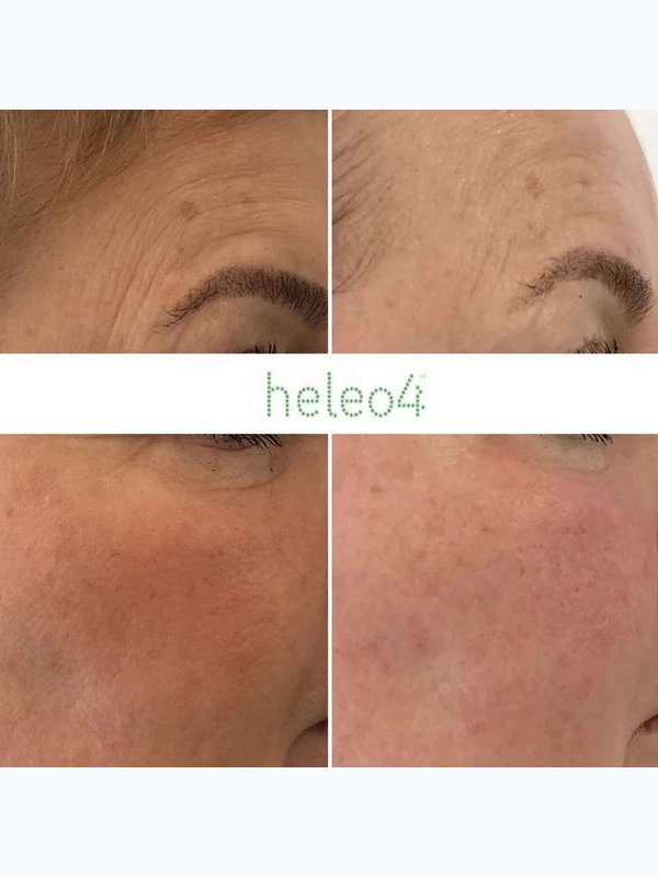 ФОТОДИНАМИЧЕСКАЯ ТЕРАПИЯ HELEO4