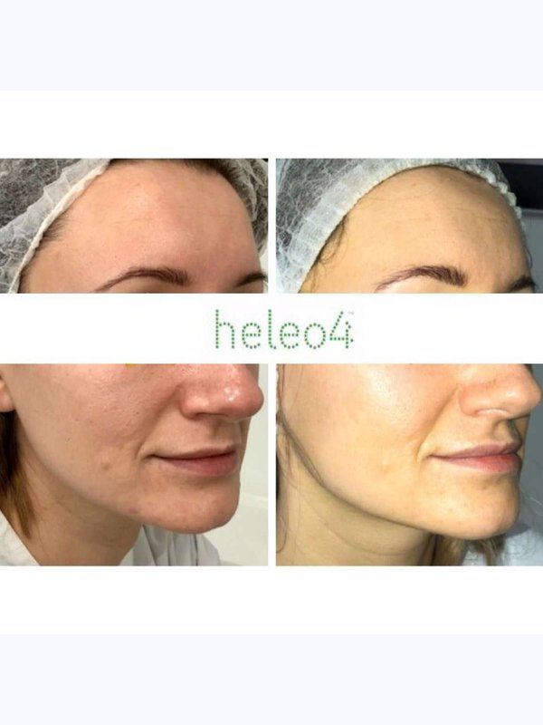 ФОТОДИНАМИЧЕСКАЯ ТЕРАПИЯ HELEO4