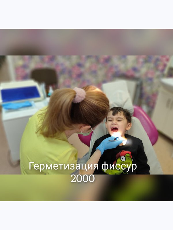 Герметизация фиссур